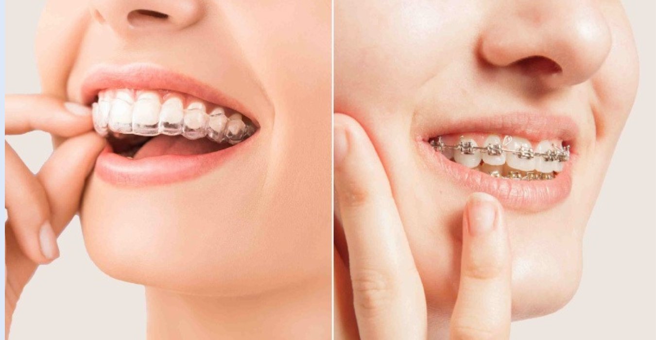 Dental Braces Treatment in Jubilee Hills & Film Nagar, Hyderabad