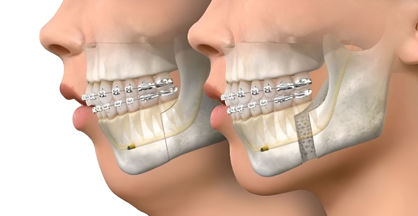 Jaw Expansion Surgery in Jubilee Hills & Film Nagar, Hyderabad