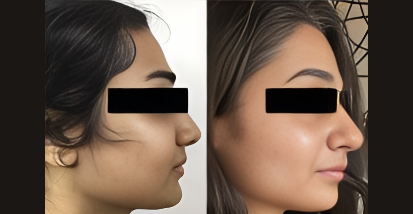 Nose Reshaping Surgery in Jubilee Hills & Film Nagar, Hyderabad