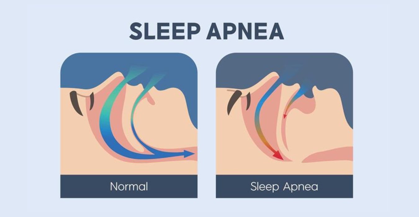 Sleep Apnea Treatment in Jubilee Hills & Film Nagar, Hyderabad