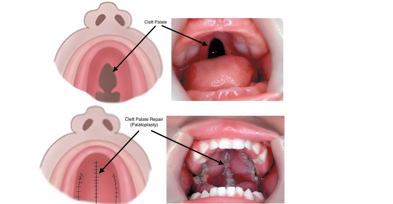 Palate Surgery in Jubilee Hills & Film Nagar, Hyderabad