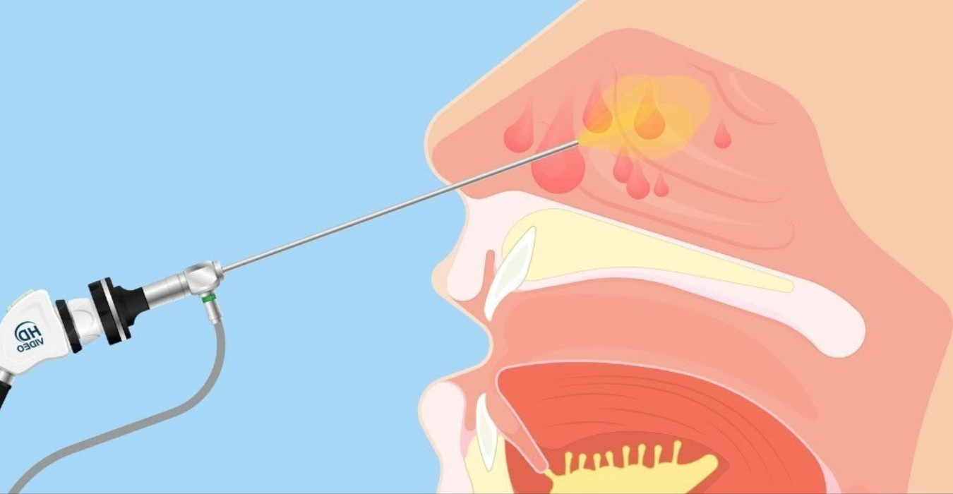 Sinus Treatment in Jubilee Hills & Film Nagar, Hyderabad