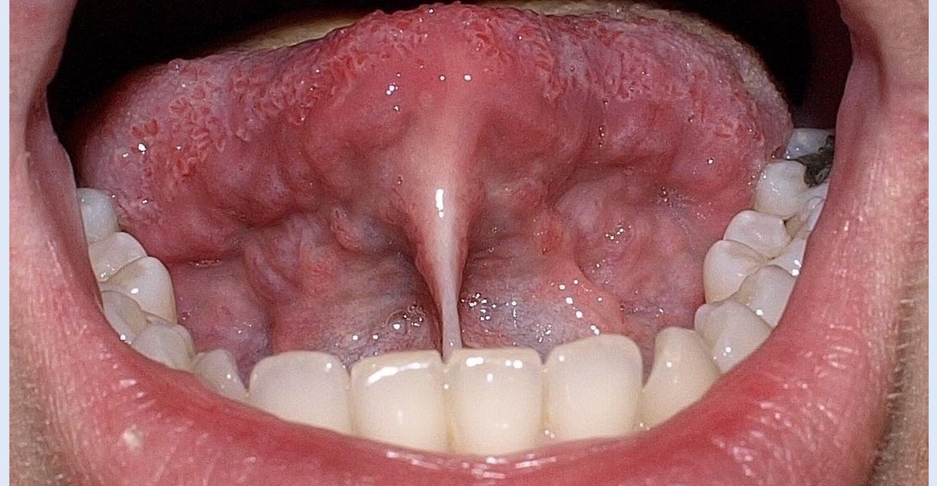 Tongue-Tie Surgery in Jubilee Hills & Film Nagar, Hyderabad