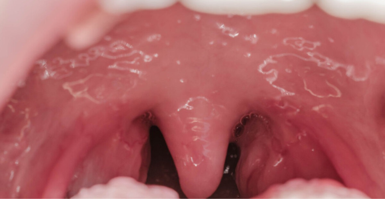Tonsil Removal Surgery in Jubilee Hills & Film Nagar, Hyderabad