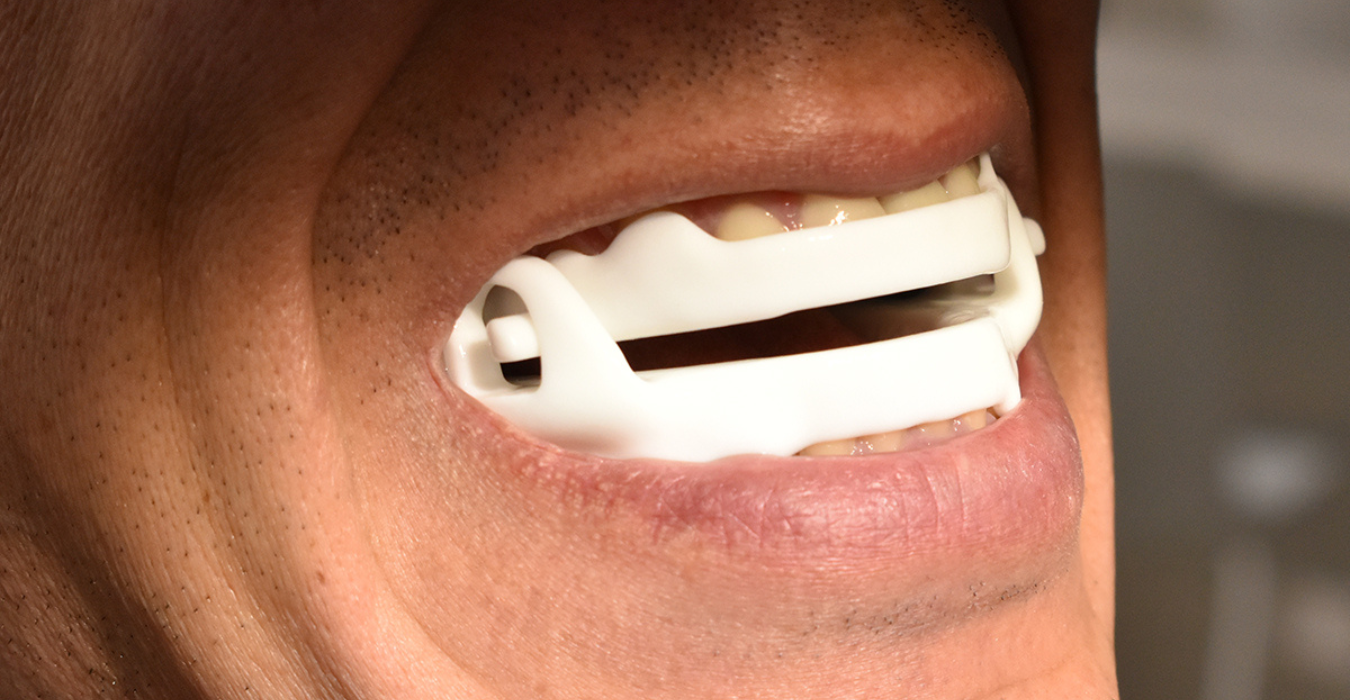 Mandibular Advancement Device Clinic in Hyderabad | Somnio The Sleep Clinic