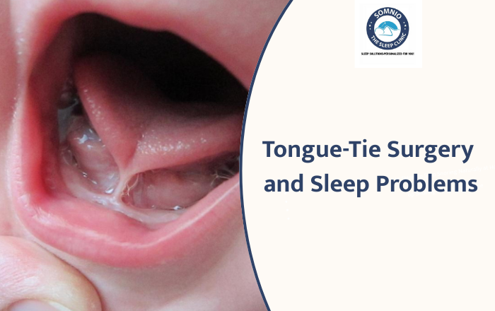 What Is Tongue-Tie Surgery and How It Helps With Sleep Problems