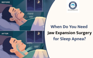 When Do You Need Jaw Expansion Surgery for Sleep Apnea?