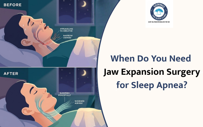 When Do You Need Jaw Expansion Surgery for Sleep Apnea?