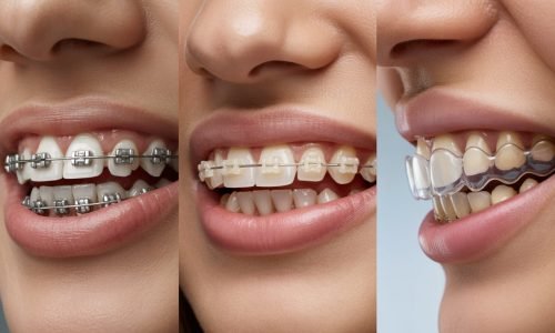 Types of dental braces metal braces, ceramic braces, and clear aligners shown for teeth straightening options.
